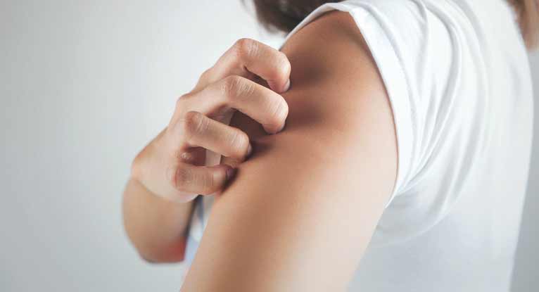 psoriasis